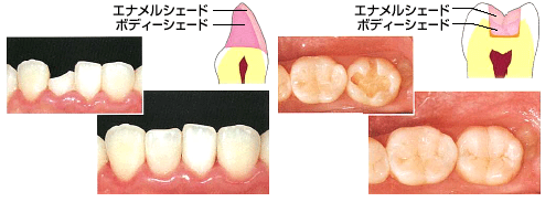 金属アレルギーの方でも安心です