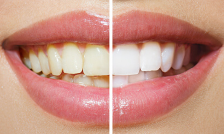 ホワイトニング後の歯