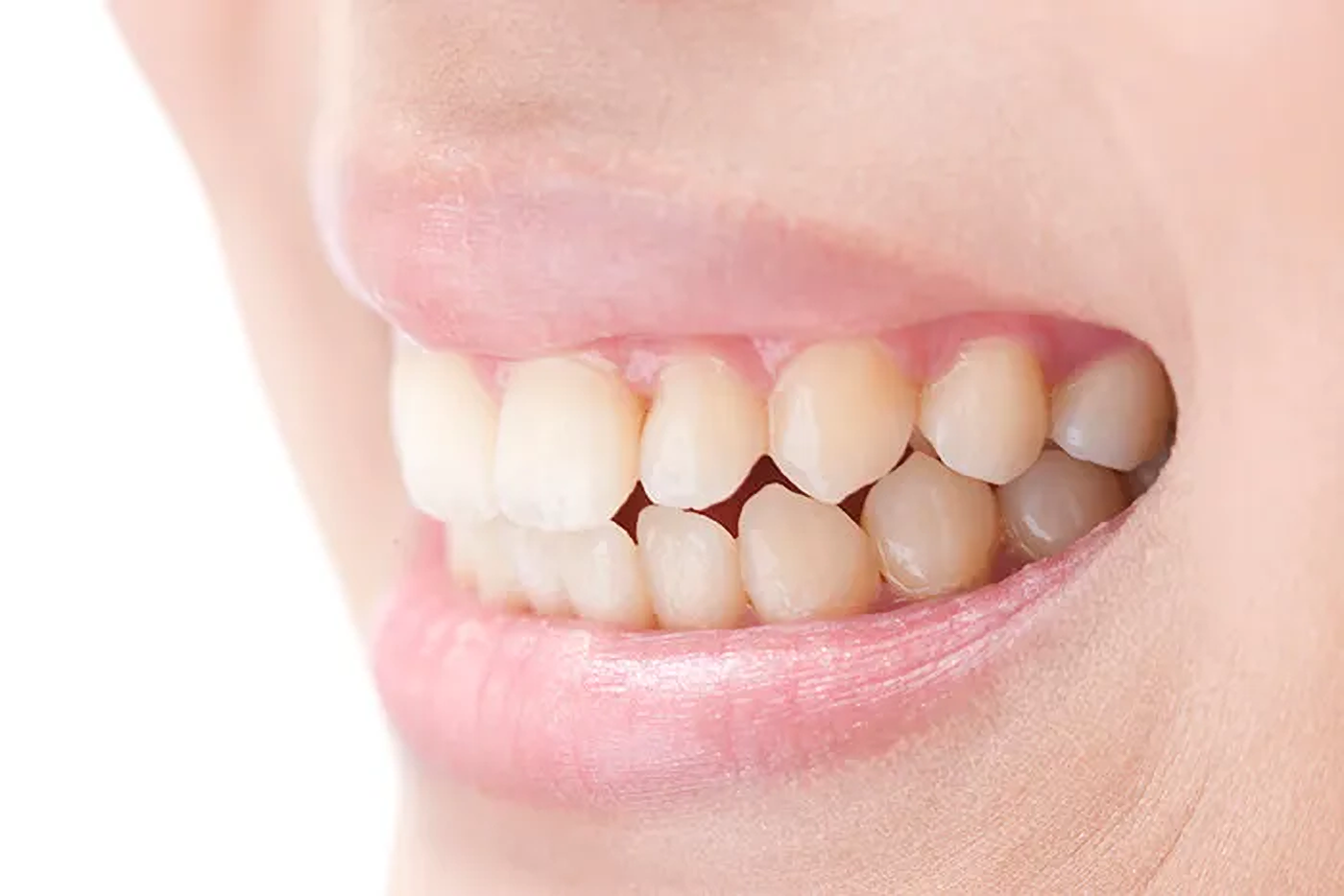 目立ちにくい入れ歯もあります