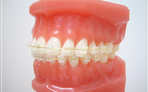 歯並び改善で虫歯予防へ