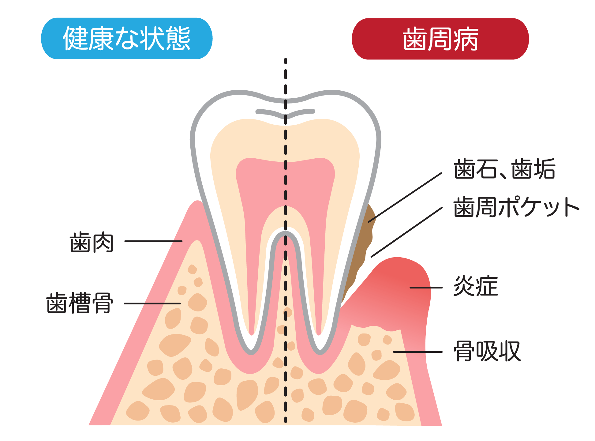 歯ぐきの出血は危険のサイン