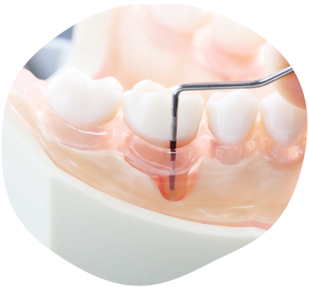 歯周病治療（経度）のイメージです。
