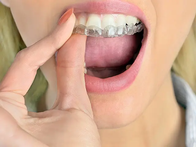 透明なマウスピース型矯正装置や舌側矯正など、目立ちにくい治療方法を選択可能
