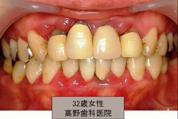 歯周病の症例