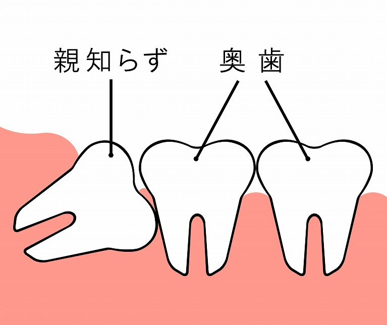 他の歯に影響を与えるものは抜歯します