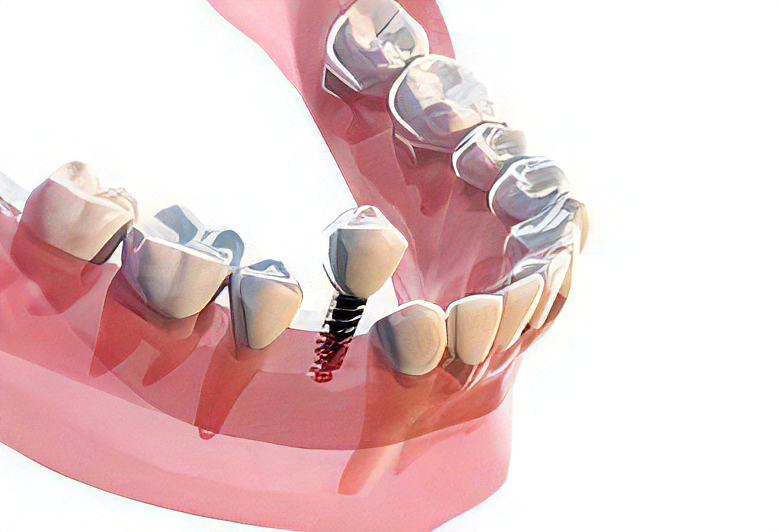 インプラント治療を提供