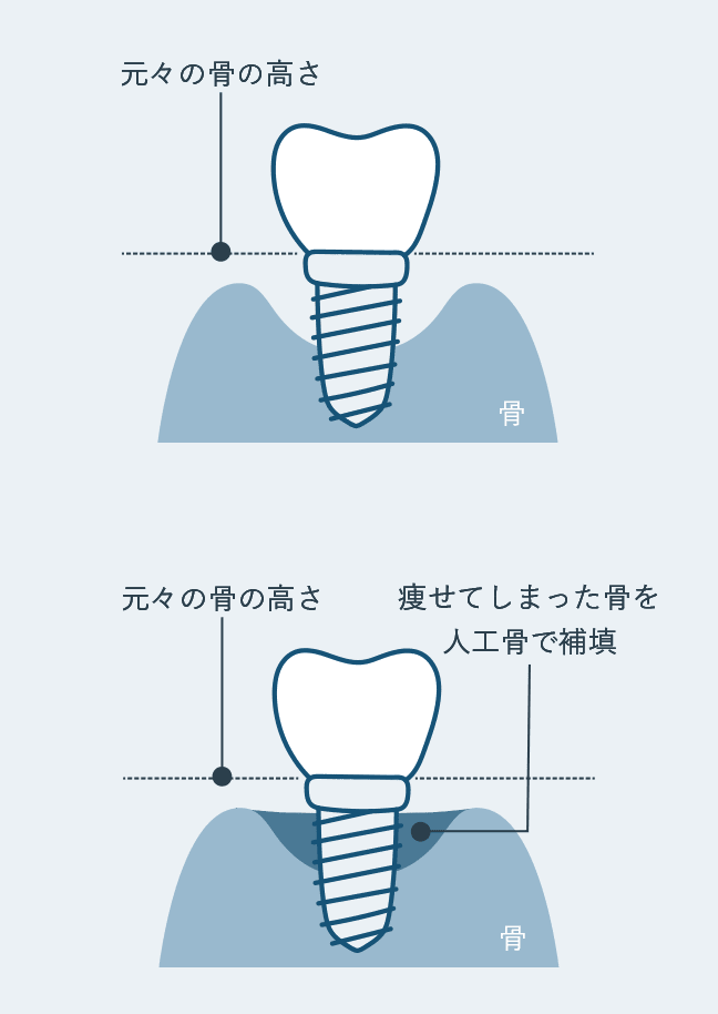 気になる症状などありましたら、インプラントのやり替え（再治療）も受けることができます