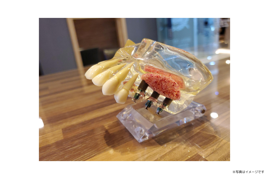 歯を失った部分の機能回復に対して、インプラント治療という選択肢を提供しています