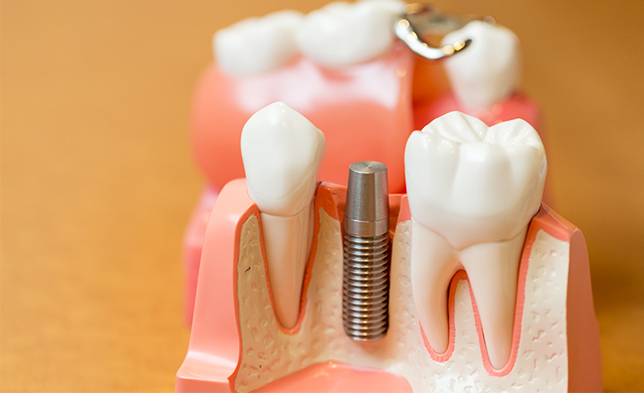 歯髄を残すことには多くのメリットがあります