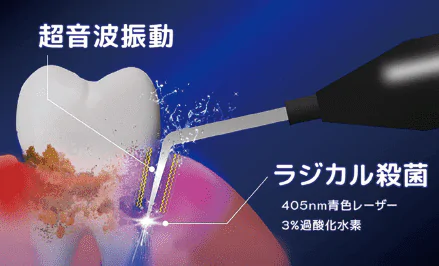 重度の歯周病にも対応できる先進的な治療機器「ブルーラジカル P-01」を導入しています