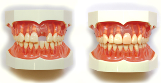 歯への負担が軽減できます