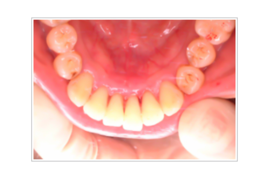 歯の表面がきれいになります