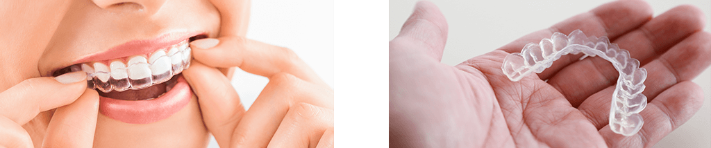 透明なマウスピース矯正と歯の裏側に装置をつける舌側矯正で、周囲に気づかれにくい治療を提供