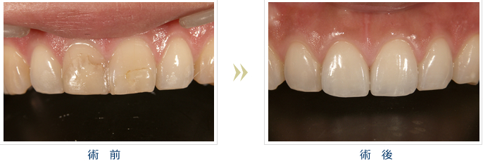 自然で美しい歯を作ります