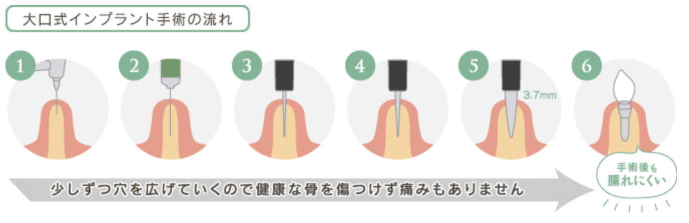 最新のインプラント技術です。