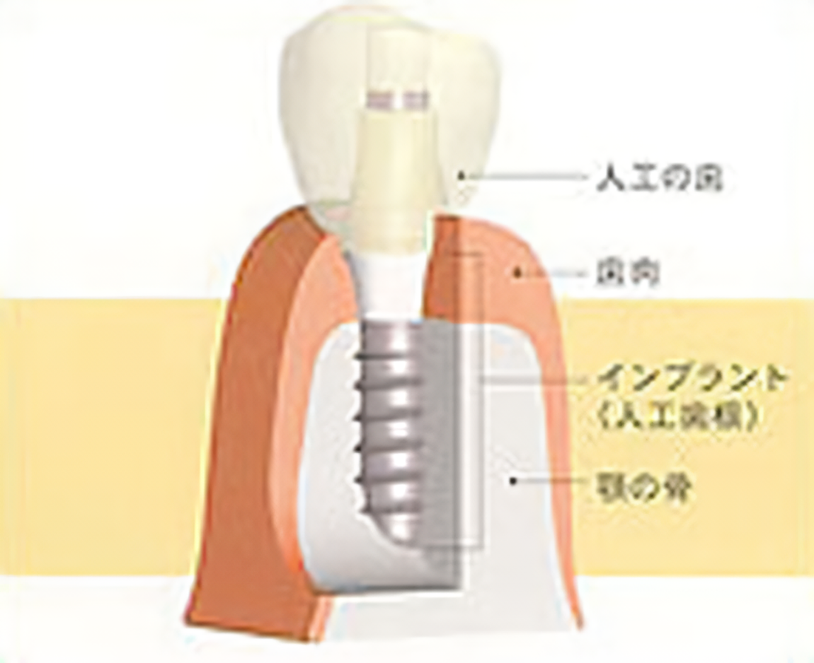 しっかり噛める喜びを取り戻す