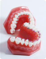 きれいな歯並びを作る治療です