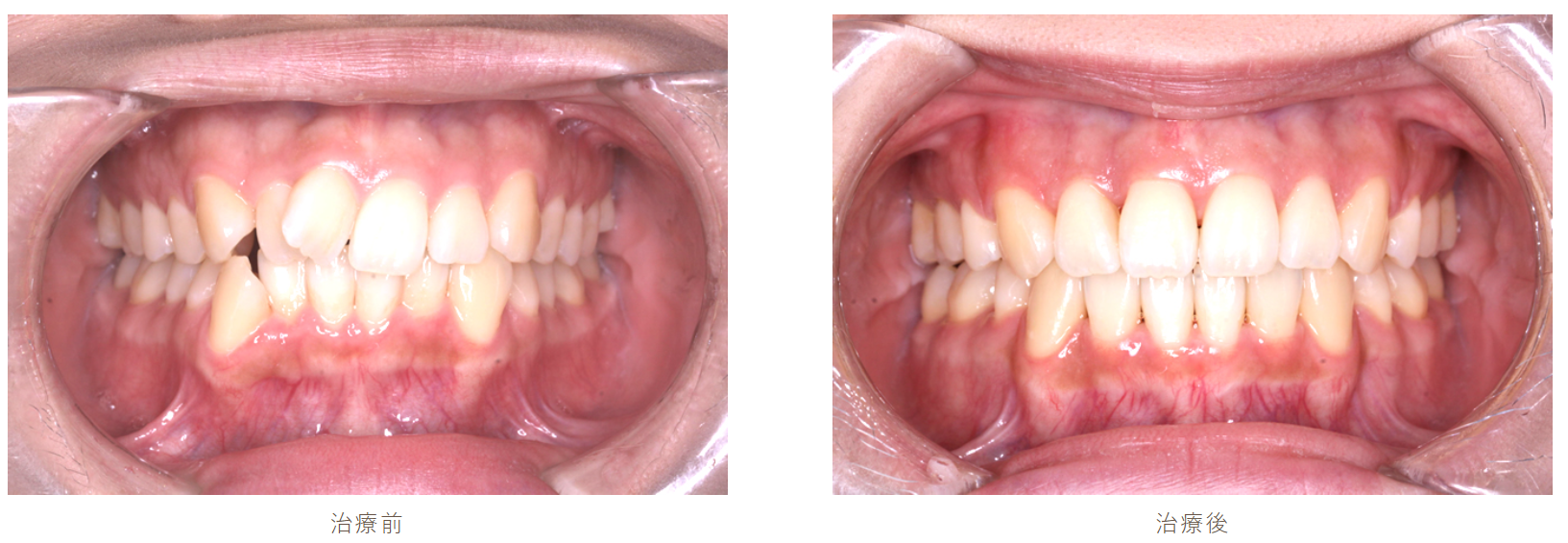 成人の歯科矯正の症例です