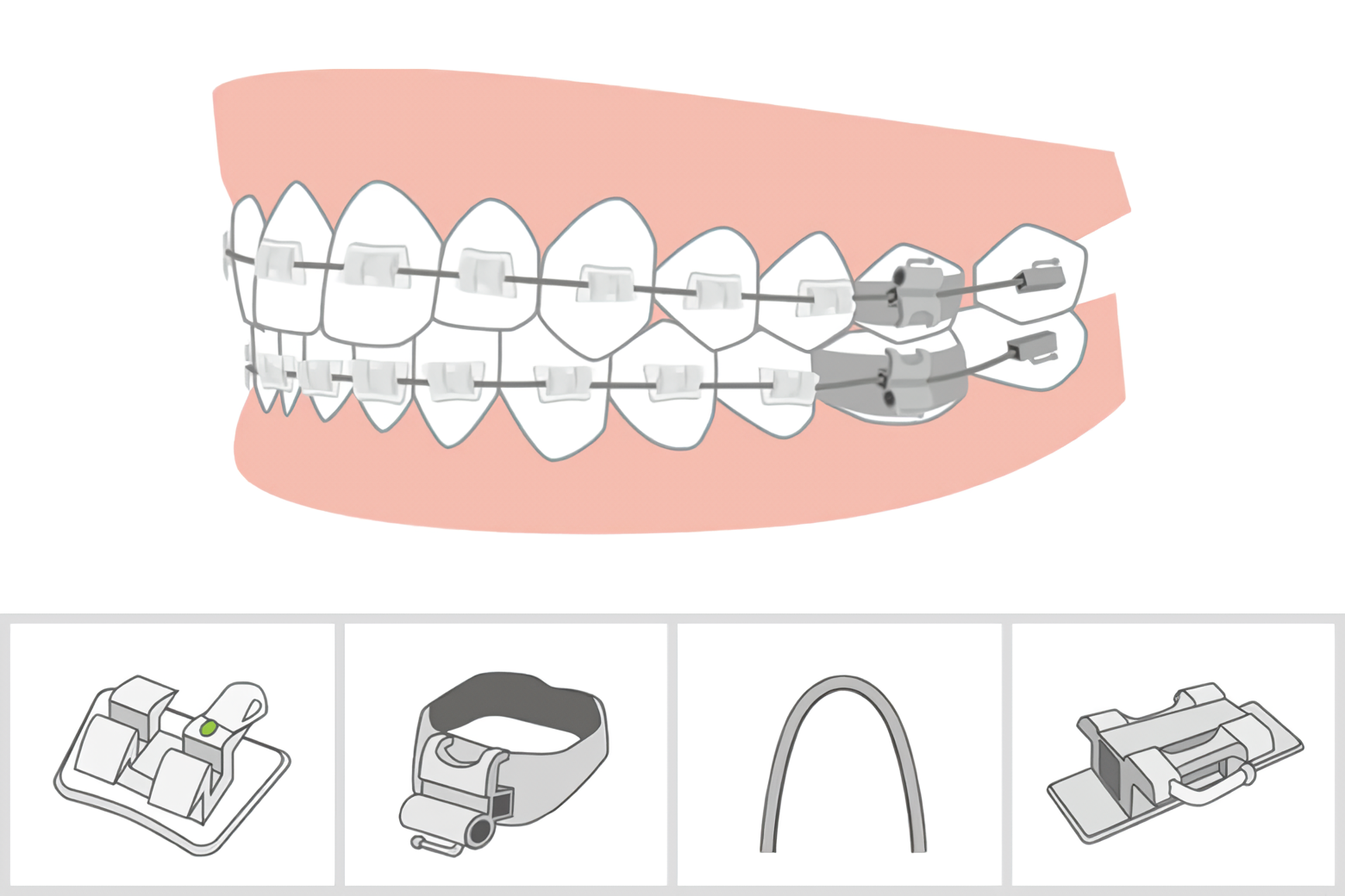 ライフスタイルに合わせて選べる矯正装置