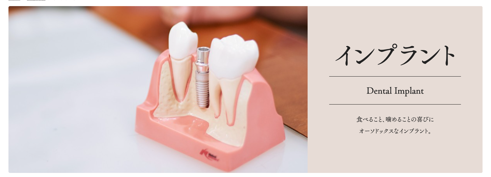 失った歯を補うための治療法として、自然な見た目と機能性を提供できる選択肢です