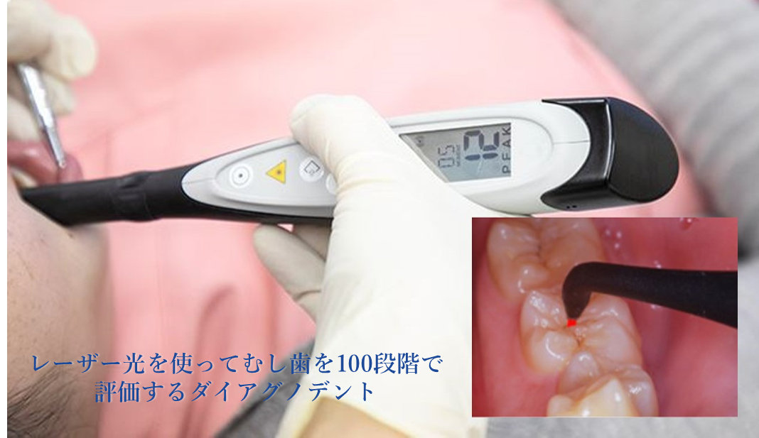 虫歯の治療-痛みを抑え、大切な歯を残すための治療