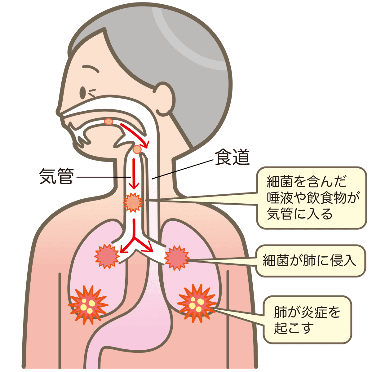 口腔ケアを行うことで、誤嚥性肺炎の予防に繋がり、全身の健康を守ることができます