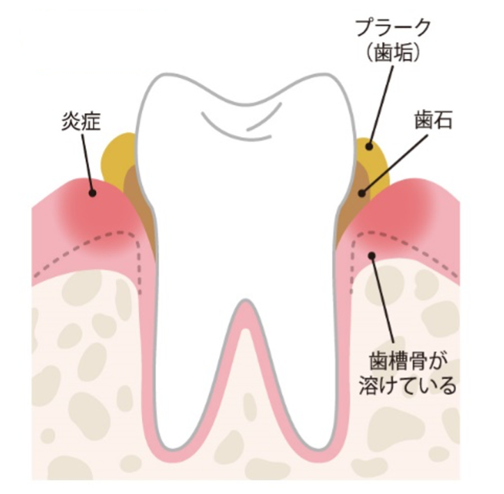 歯周病は早期の治療と予防が重要であり、定期的なケアが最も効果的です