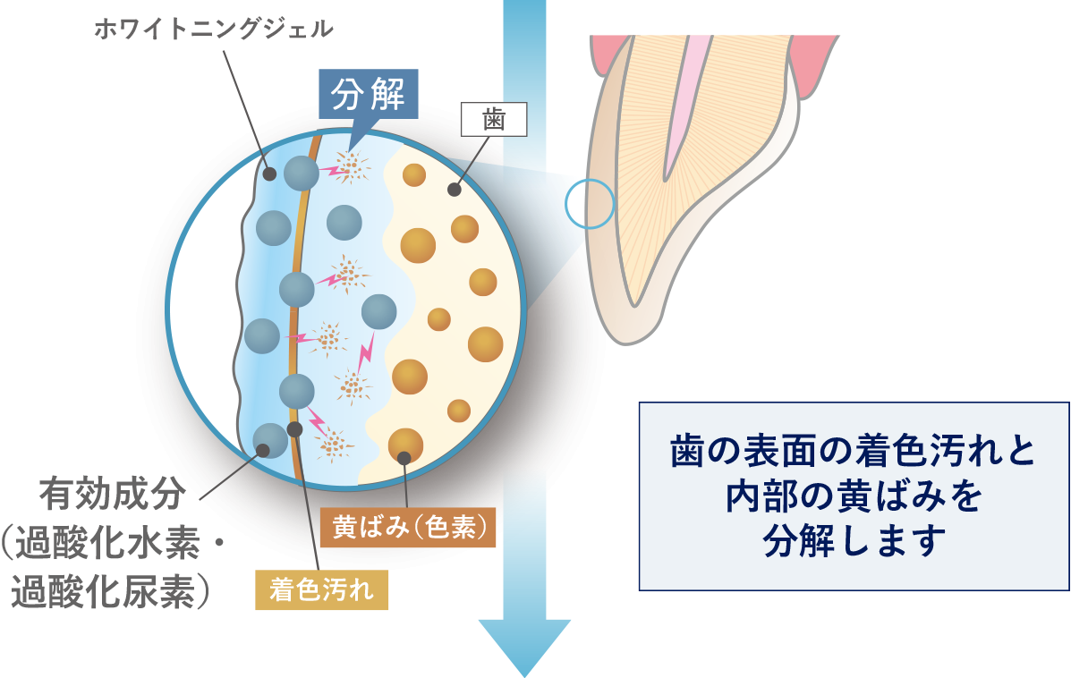医療ホワイトニングを通じて、患者様の歯を内側から白く美しい状態へと導いています