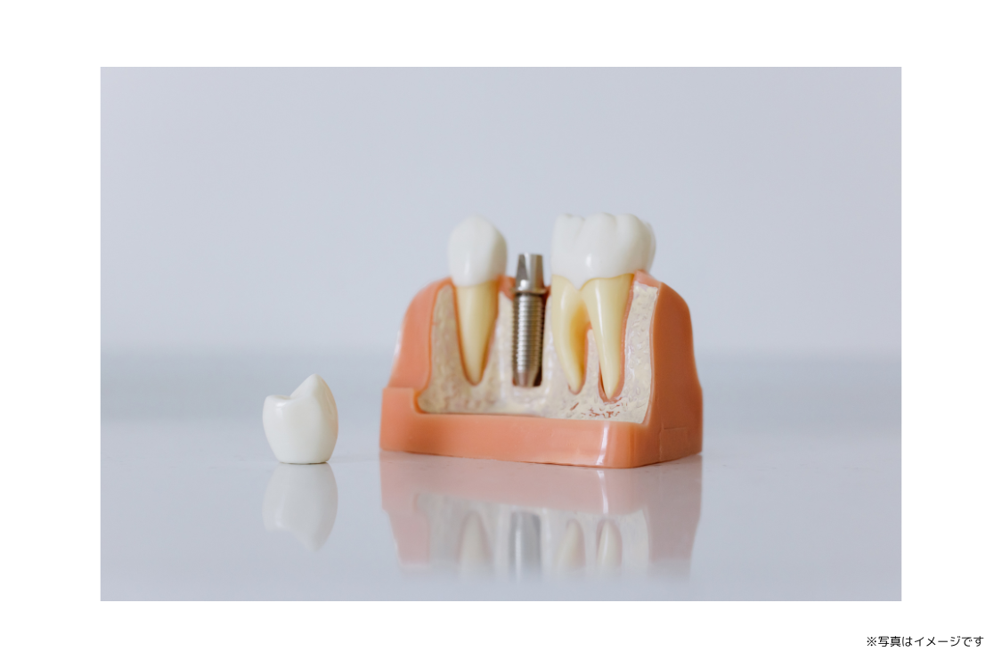 人工歯根の安定性と日常機能の再獲得を重視しています