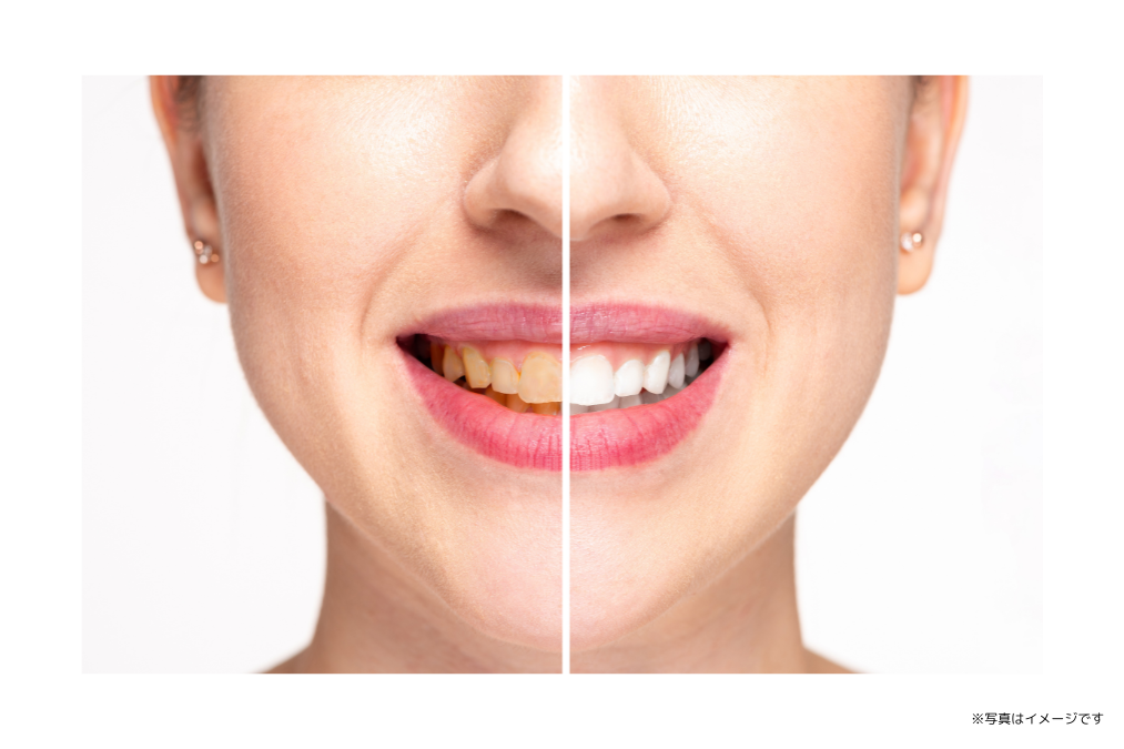 ホームホワイトニングとオフィスホワイトニングの両方に対応