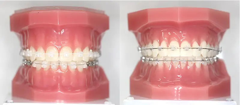 透明や白色の目立たない装置で審美性に配慮した矯正治療です