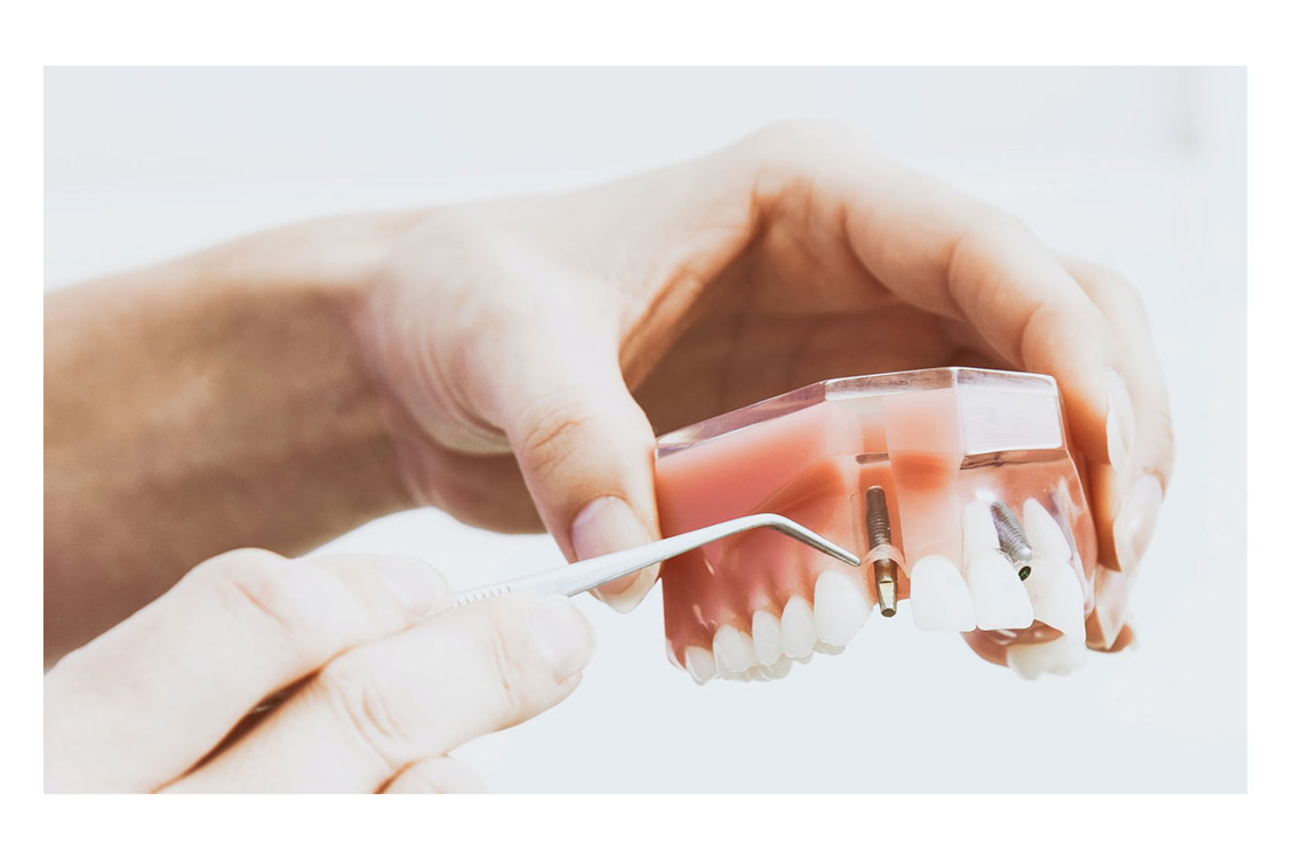インプラント治療