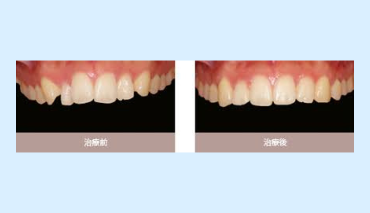 審美性重視の矯正治療
