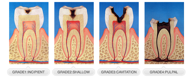 虫歯の進行について