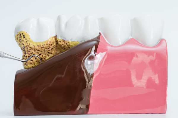 歯ぐきの状態を見極め、負担の少ない歯周病治療を提供