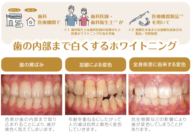 歯科医師の診断に基づく専門的なホワイトニングで自然な白さを実現