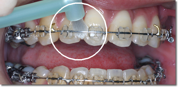 かみ合わせと口元の仕上がりを重視しています
