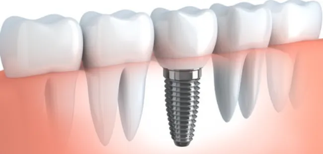 歯を失った患者様が再びしっかり噛めるようになるためのインプラント治療に対応しています