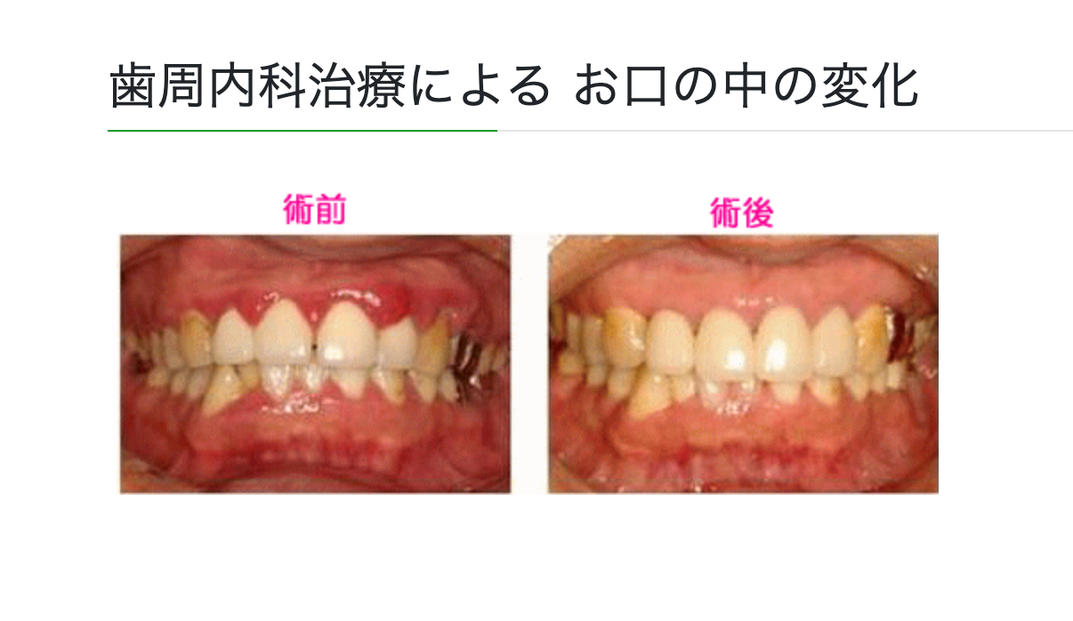 歯周内科治療と、YM療法を組み合わせた治療を行っています