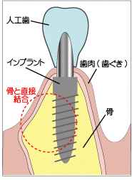 食べ物の味や温度も感じられ、審美性、装着感、機能性の面で優れた治療です。