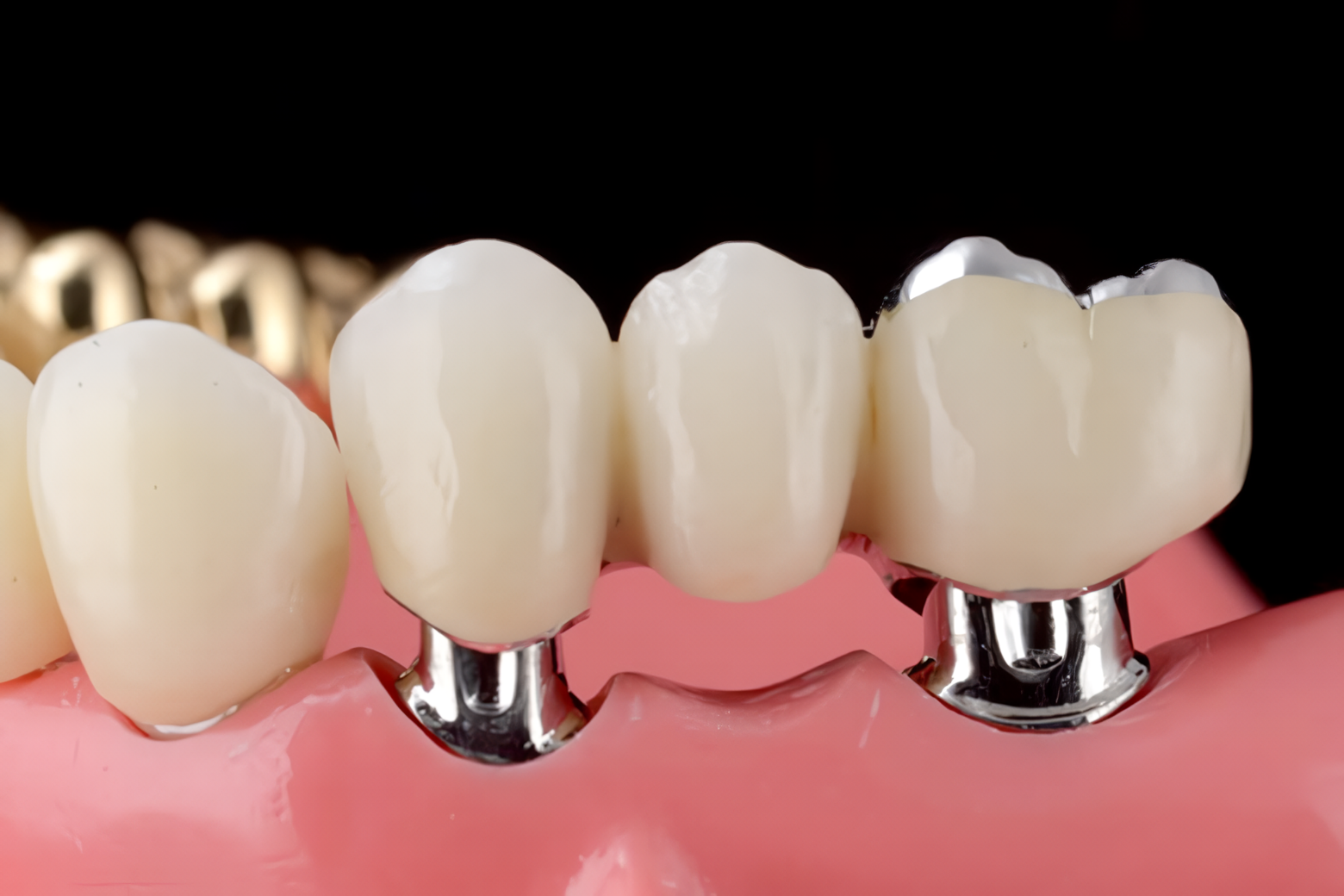 見た目も機能も自然な歯を再建