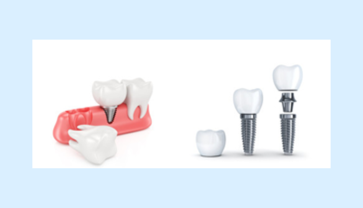 インプラントも対応