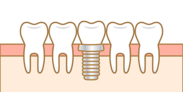 失われた歯の機能と見た目を回復する手段としてインプラント治療を提供しています
