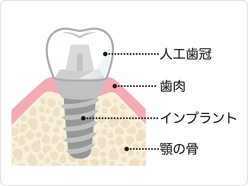 自然な歯と同じように使えるため、食事や会話にも支障がなく、患者様の生活の質を大きく向上させることができます。