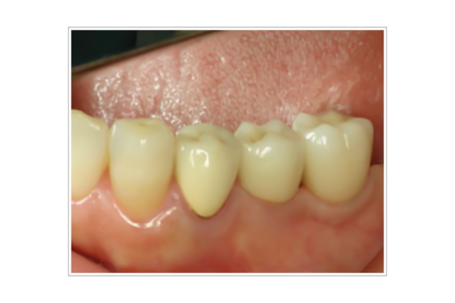 治療から5年後の状態