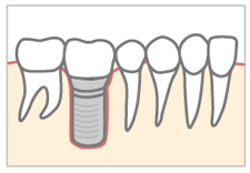 高精度なデジタル設備と信頼の実績で安心のインプラント治療