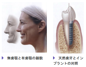 歯が抜けてしまって諦めてはいませんか?