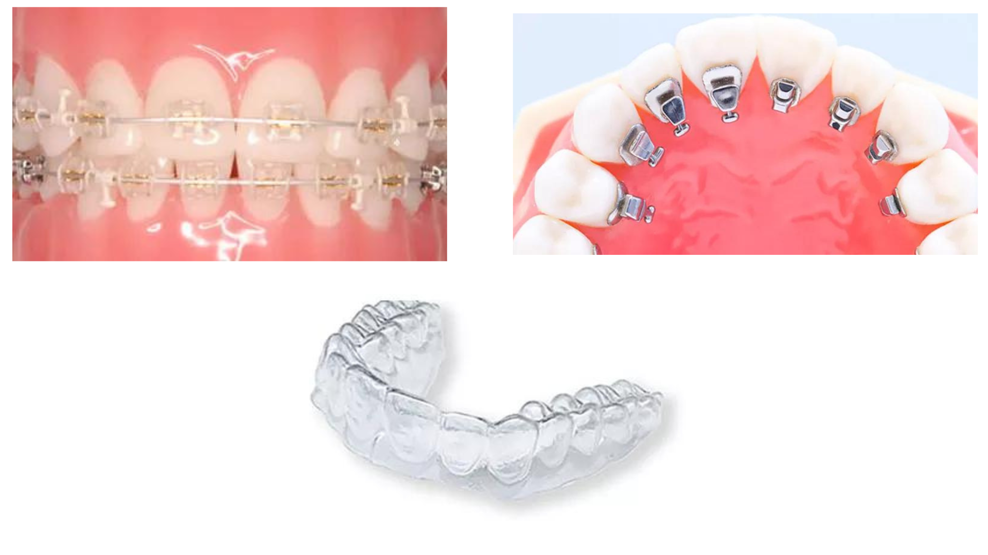 目立たない歯科矯正