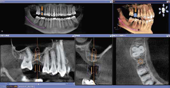 ①マイクロスコープを導入②歯科用CTを導入③精密CT画像