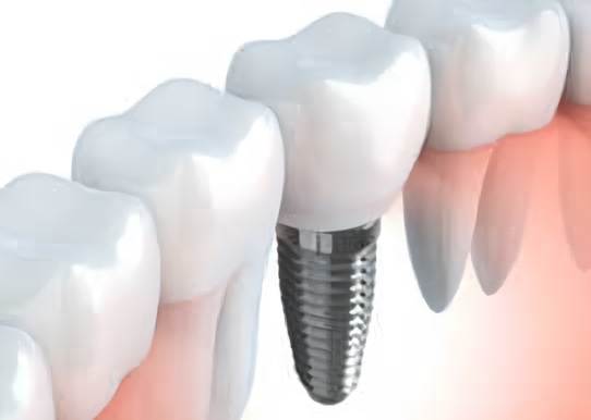 人工歯が顎にしっかりと固定されます